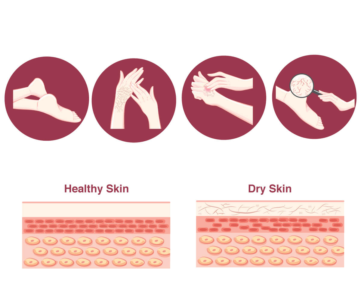 Infographic on dry skin