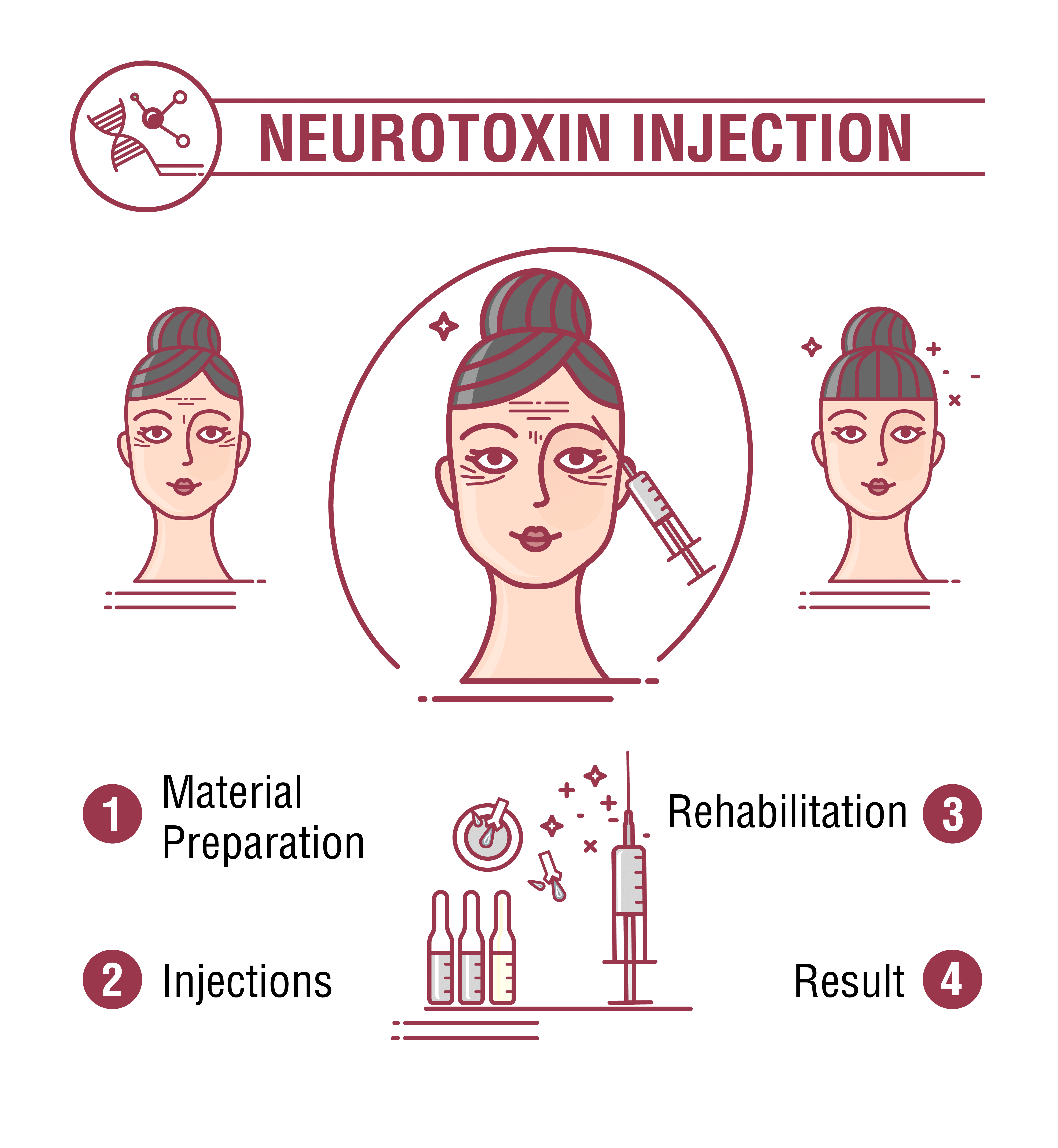 Infografía sobre inyección de neurotoxinas (botox)