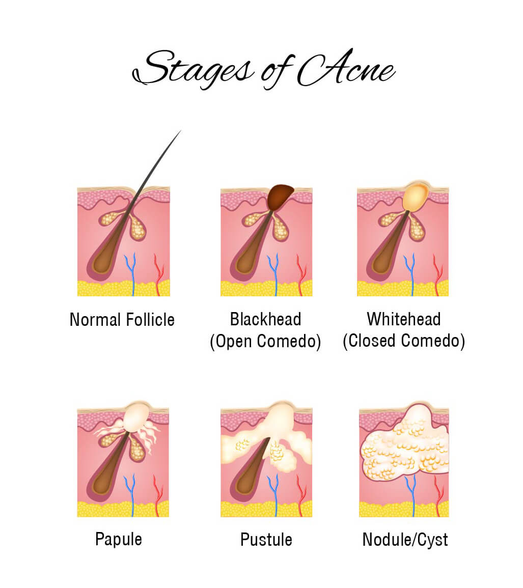 Infografía sobre las etapas del acné.