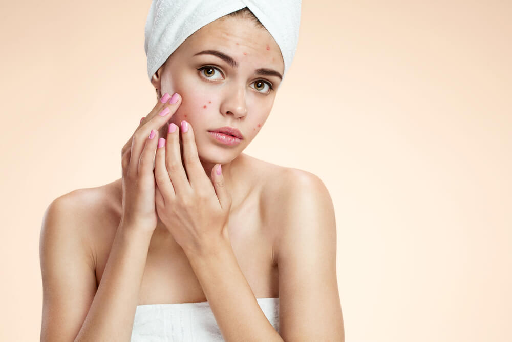 7 Remedies for Acne You Should Try