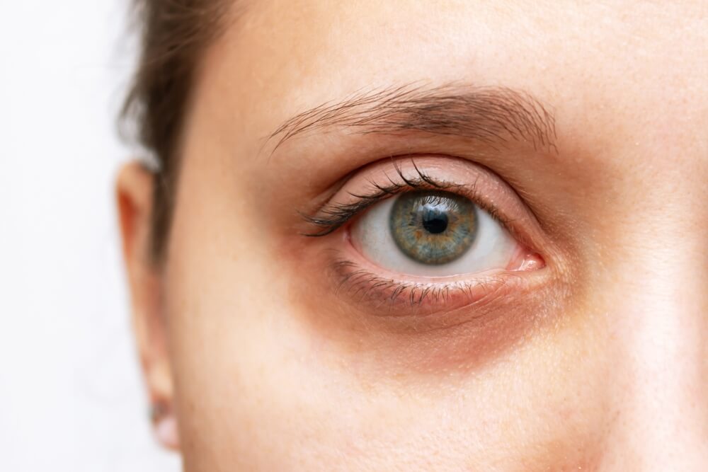 How To Get Rid Of Dark Circles Under Your Eyes Vine Vera